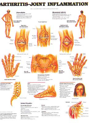 arthritis joint inflammation chart